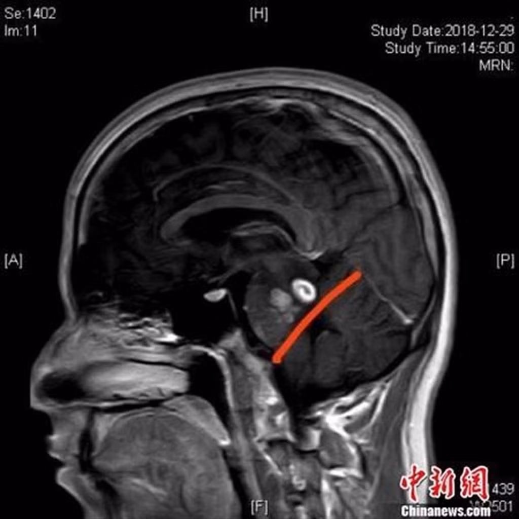 An ech de chua gay xuong, nguoi dan ong gap hoa kinh di...