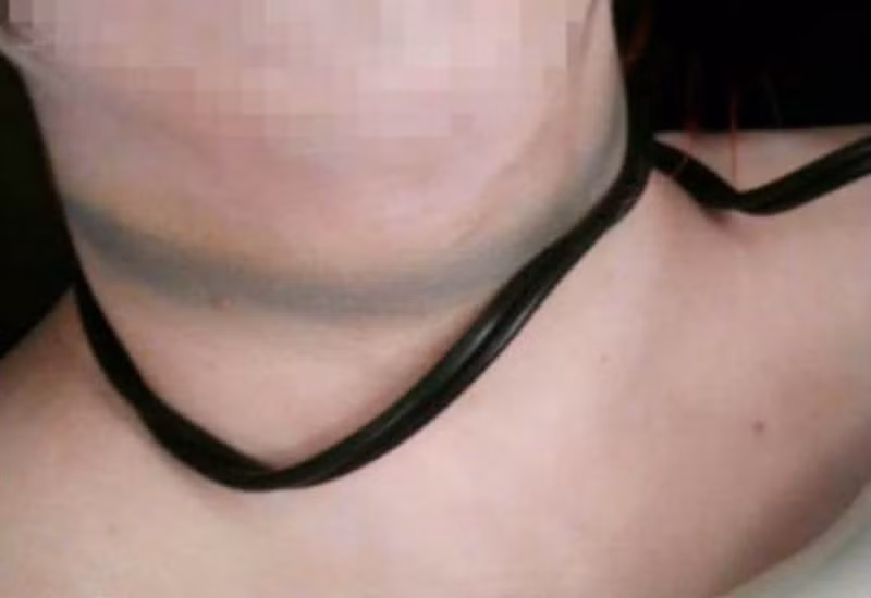 Theo các chuyên gia, những kẻ giết người thường chọn phương pháp thứ hai, vì nó cần 30 kg lực để siết cổ một người và chỉ cần 5 kg lực, để chặn sự tiếp cận của oxy lên não. Một người phụ nữ trưởng thành đủ sức khoẻ để có thể làm tốt việc này. 