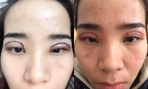 Spa Thanh Nguyen 465 Thuy Khue: Cat mi gay nhiem trung cho khach