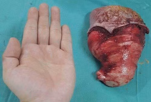 Liên tiếp phẫu thuật thành công nhiều ca bệnh hiếm đầu năm 2017 - Hình 2 Lien tiep phau thuat thanh cong nhieu ca benh hiem dau nam 2017-Hinh-2