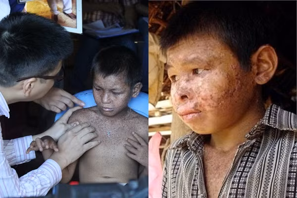 Bệnh tái đi tái lại nhiều lần, mùa hè bệnh nặng hơn. Bệnh thường lan từ đầu xuống má, miệng, mũi, cổ vai, lưng, quanh hốc mắt, gây ngứa ngáy, đau đớn cho người mắc bệnh...