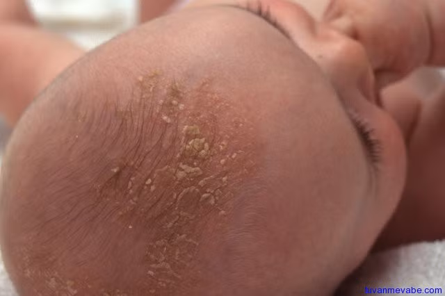 Hội chứng Trichotillomania có thể mắc phải ở trẻ sơ sinh, tuy nhiên thời điểm phát bệnh cao nhất ở tuổi từ 9 - 13 thời kỳ có những thay đổi lớn về tâm sinh lý cơ thể. Hội chứng này cũng có thể được kích hoạt khi bị trầm cảm hay stress.