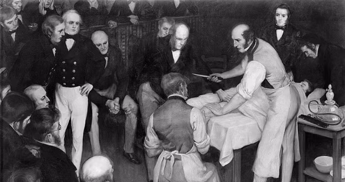  2. Ca phẫu thuật có tỷ lệ tử vong 300%: Vào năm 1847, bác sỹ Robert Liston – người được cho là sở hữu tốc độ phẫu thuật nhanh nhất thế giới đã thực hiện cuộc phẫu thuật cắt bỏ chân của một bệnh nhân. Mọi quу trình vẫn diễn ra bình thường cho đến khi người bệnh bắt đầu lăn lộn vì quá đau. Các trợ lý cố gắng hết sức để giữ bệnh nhân.
