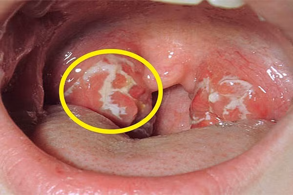 Đau rát họng, khản tiếng là một trong những dấu hiệu cảnh báo sớm ung thư vòm họng ngay ở giai đoạn đầu. Ảnh: ksol.