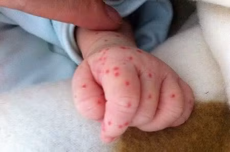 Bên cạnh xuất huyết dưới da người bị sốt xuất huyết còn chảy máu cam, chảy máu chân răng, nướu răng.