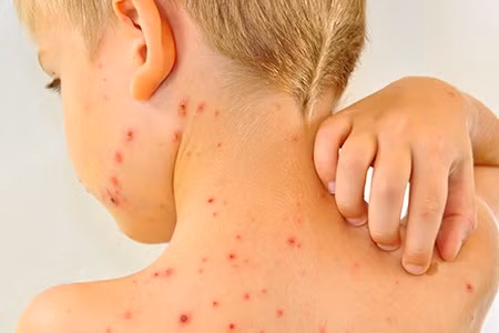 Dấu hiệu nặng hơn của bệnh sốt xuất huyết là sốc. Dấu hiệu này thường xuất hiện từ ngày thứ 3-6 của bệnh, đặc biệt lúc trẻ đang sốt cao chuyển sang hết sốt và có thể xảy ra kể cả khi không thấy rõ dấu hiệu xuất huyết.