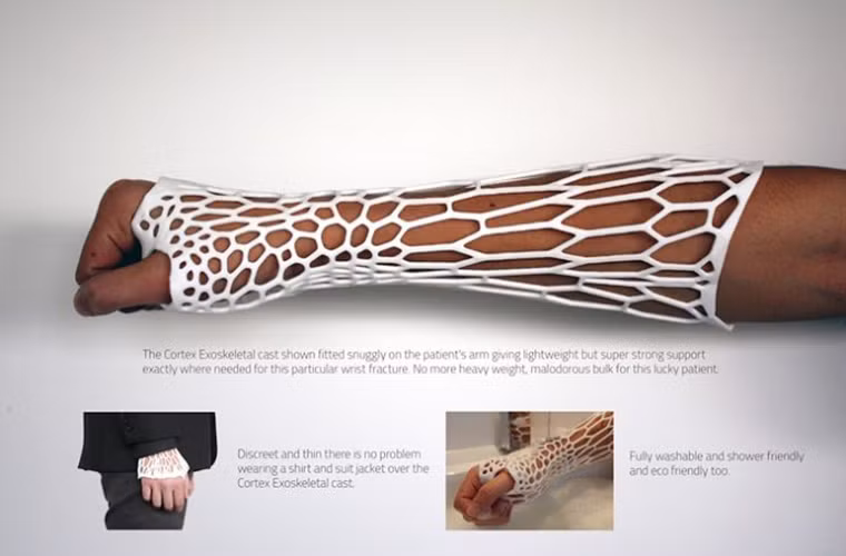  Lưới chỉnh hình của tương lai: Có tên gọi là Cortex Exoskeletal, túi lưới làm bằng chất liệu ny-lông này được tạo từ công nghệ in 3D, có thể xem là một sự thay đổi quan trọng đầu tiên sau nhiều thập niên để thay thế loại lưới chỉnh hình đúc bằng sợi thủy tinh được dùng để điều trị xương tay bị gãy.