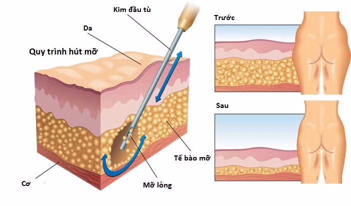 Số phận bi thảm của cô gái đầu tiên hút mỡ trong lịch sử - Hình 2 So phan bi tham cua co gai dau tien hut mo trong lich su-Hinh-2