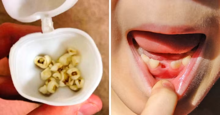 Hãy giữ lại những chiếc răng sữa vì chúng chứa tế bào gốc, có thể sử dụng để tái sinh tế bào thần kinh, tế bào xương và thậm chí là tế bào tim. Các bậc phụ huynh nên tham vấn nha sĩ cách lưu giữ và bảo quản răng sữa của trẻ nhỏ sau khi trẻ thay răng./.