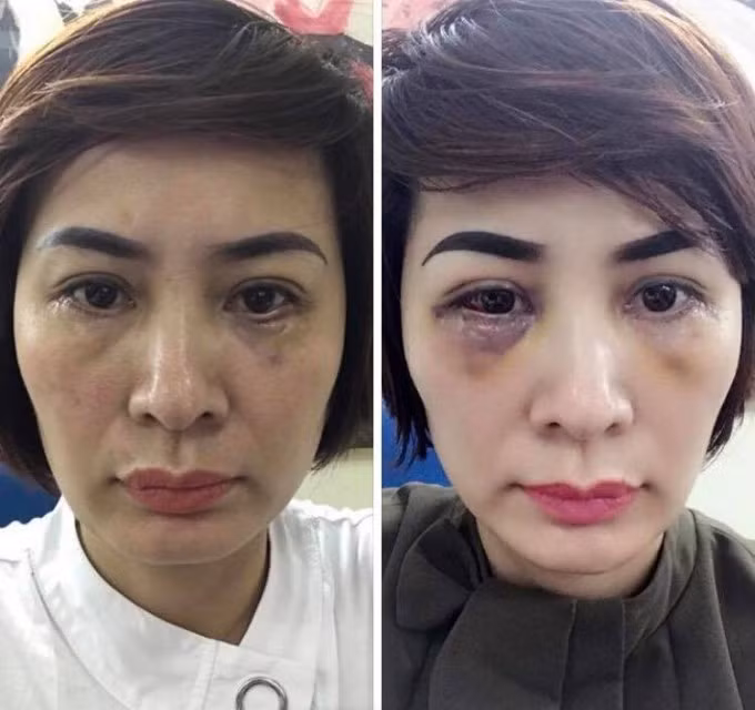 Mắt của chị Trần Lệ Thúy sau gần 1 tháng cắt mỡ mí dưới tại Thẩm mỹ viện Lilia. Ảnh: Phapluatplus.