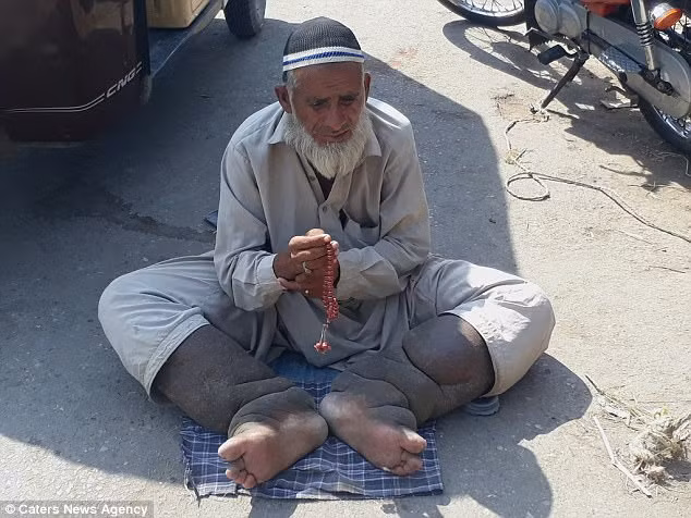Ông Muhammad Saleem được gọi là “người đàn ông có đôi bàn chân voi” ở Karachi ở Pakistan. Do mắc phải chứng hạch bạch huyết khiến đôi chân to như chân voi, ông Muhammad buộc phải đi ăn xin trên đường suốt 17 năm qua vì không thể làm được gì. Ảnh: CNA.