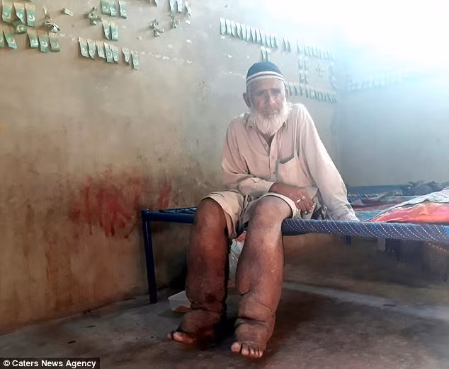 Ông Muhammad chia sẻ: "Chân tôi quá nặng. Tôi không thể đứng yên được hai phút ở một nơi. Đi lại là một việc rất khó khăn đối với tôi. Đã hơn 20 năm nay tôi không thể tự đi lại, không thể tự làm việc gì, kể cả việc đeo giày”. Ảnh: CNA.