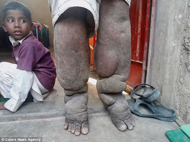 Bàn chân của ông đã phát triển đến một chu vi khổng lồ là 23cm và các ngón chân của ông là 18cm. Vì sức nặng và kích thước khổng lồ của đôi chân, ông Muhammad gần như hoàn toàn bất động. Ảnh: CNA.