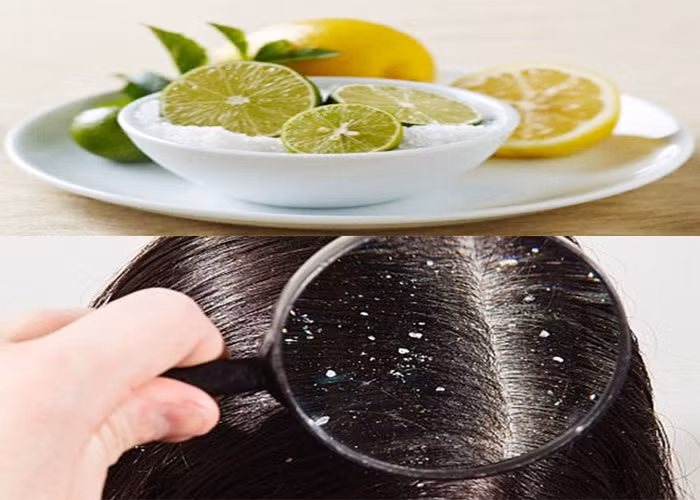 Hé lộ cách trị gàu bằng muối “tiêu diệt” hiệu quả hàng triệu vi khuẩn - Hình 3 He lo cach tri gau bang muoi “tieu diet” hieu qua hang trieu vi khuan-Hinh-3
