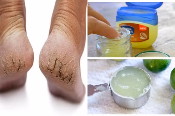 3 cách dùng vaseline trị nứt gót chân không phải ai cũng biết - Hình 3 3 cach dung vaseline tri nut got chan khong phai ai cung biet-Hinh-3