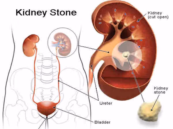 Thận được tạo thành từ hàng triệu tế bào nhỏ xíu được gọi là nephrons. Chúng là những chất lọc máu không tinh khiết xâm nhập vào thận. Sau đó máu sẽ được làm sạch và trở lại cơ thể để lưu thông. Do đó, thận là cơ quan rất quan trọng đối với hoạt động của cơ thể. Nếu bạn đang bị sỏi thận, hãy tham khảo một số biện pháp khắc phục tự nhiên để loại bỏ sỏi thận thay vì phẫu thuật. Ảnh: Boldsky.