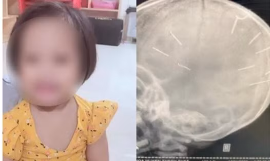  Bé gái 3 tuổi bị cắm 9 cây đinh vào đầu: Chiều 17/1/2022, Bệnh viện Thạch Thất đã tiếp nhận bé Đ.N.A. nhập viện trong tình trạng hôn mê, co giật. Đáng chú ý, sau khi các bác sĩ tiếp nhận bệnh nhân, tiến hành đặt ống, chụp phim đã phát hiện trên hộp sọ cháu bé có 9 cái đinh. Trong quá trình kiểm tra, thăm khám, các bác sĩ phát hiện cánh tay phải của bé đã được bó bột trong 2 tuần. 