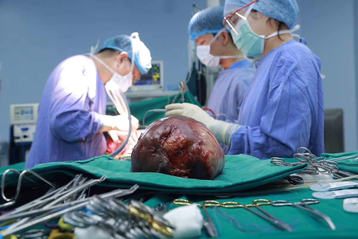 Phẫu thuật thành công khối u gan chiếm gần hết ổ bụng Phau thuat thanh cong khoi u gan chiem gan het o bung
