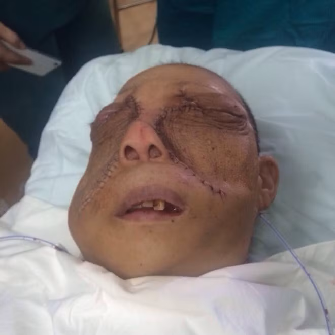 Ghe so khoi u khong lo khong tuong noi tren mat-Hinh-2