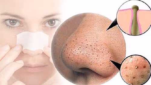 Loại bỏ tác nhân gây mụn đầu đen. Làn da bị xâm hại bởi hóa chất, khói bụi, không khí ô nhiễm sẽ rất dễ bị “ngộ độc” và có nguy cơ phải đối mặt với những rắc rối như viêm da, viêm nang lông, tiết nhiều chất nhờn, cặn bã và mụn trứng cá là kẻ thù đáng sợ nhất của da trong tình trạng này.