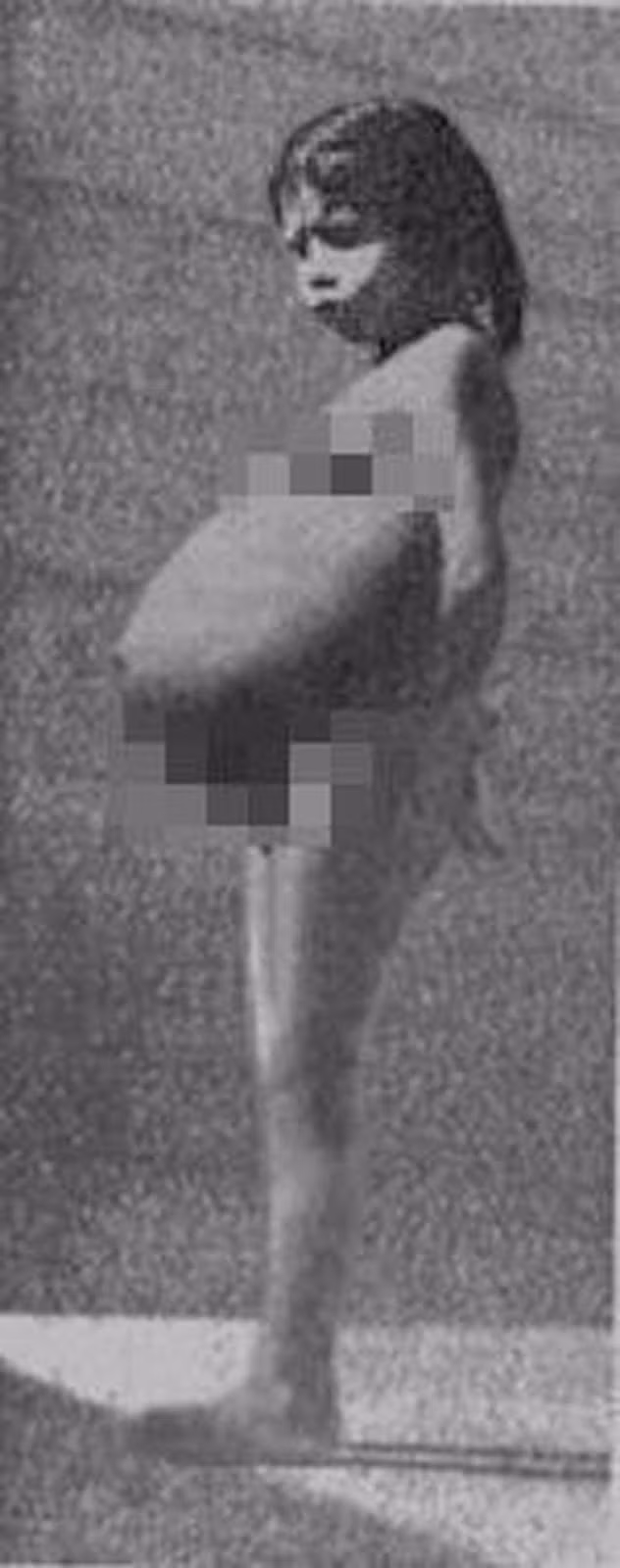 Năm 1939, Lina Medina ở Peru, sinh một bé trai khỏe mạnh. Điều đáng nói là Lina sinh con khi 5 tuổi. Vì vậy, bé gái này đã trở thành người mẹ trẻ nhất thế giới. Trong ảnh là Lina khi mang thai.