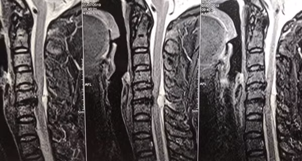 2 tiếng mổ cấp cứu “giải phóng” bệnh nhân liệt toàn thân vì giác hơi 2 tieng mo cap cuu “giai phong” benh nhan liet toan than vi giac hoi