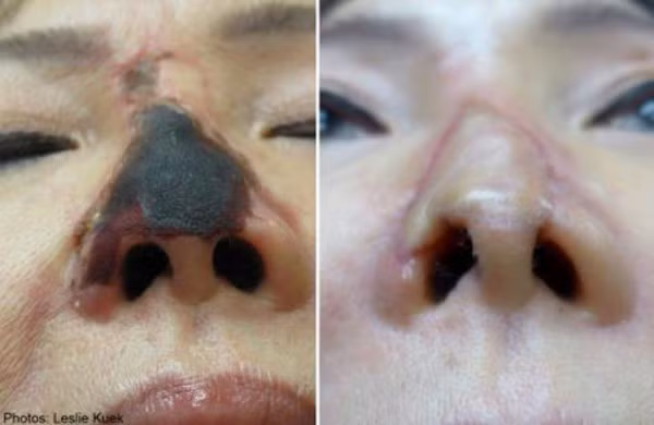 Chất làm đầy trên thị trường hiện nay được bày bán tràn lan, khó kiểm soát nguồn gốc và chất lượng. Nếu như bạn lựa chọn địa chỉ thẩm mỹ không uy tín, tiêm chất làm đầy kém chất lượng có thể dẫn đến hệ quả là mũi bị hoại tử, thậm chí là biến dạng vĩnh viễn nếu không được chữa trị kịp thời.