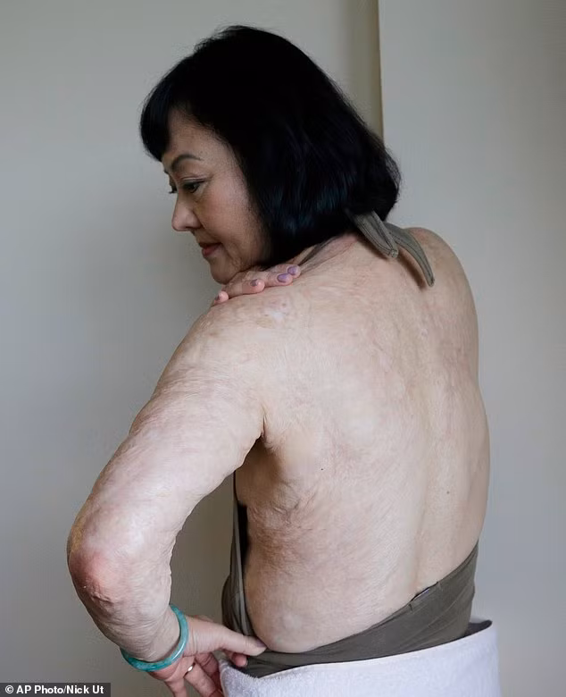 Vài tuần sau đợt điều trị ban đầu, Kim Phúc cho biết vết sẹo của bà đã đỏ, căng và ngứa, nhưng vẫn muốn tiếp tục điều trị. "Có lẽ phải mất một năm. Nhưng tôi thực sự vui mừng và biết ơn", bà nói.