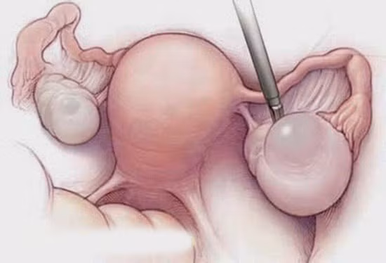 U nang buồng trứng thường chỉ được phát hiện khi đi khám phụ khoa, siêu âm một số bệnh khác, hoặc qua kiểm tra sức khoẻ tổng quát.