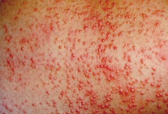 Khi tình trạng này kéo dài hơn 12 tiếng, bạn cần đi khám da liễu ngay bởi nếu để lâu có thể dẫn đến bệnh ung thư da.