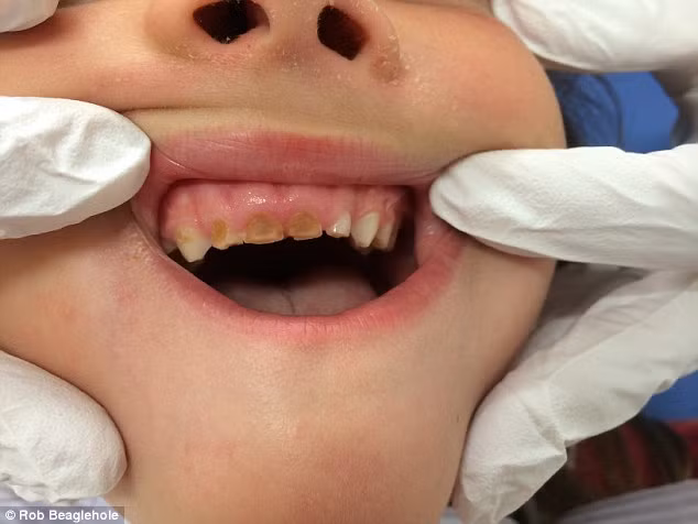Răng của đứa trẻ này đã bị hỏng do uống đồ uống có ga thường xuyên.