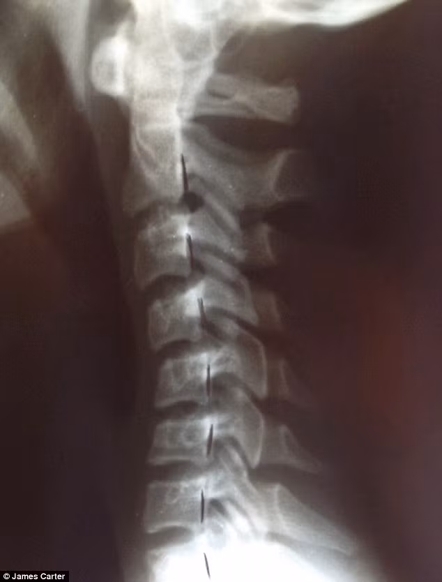 Hình X-ray cột sống của một cô gái 16 tuổi bị cong hình chữ S do hiệu ứng cúi xuống nhìn điện thoại.