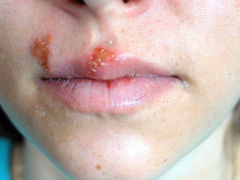 Khoảng 1/3 các trường hợp không được điều trị phát triển thành giai đoạn cuối có thể gây hại não, tổn thương thần kinh, mắt, tim, mạch máu, gan, xương và khớp.