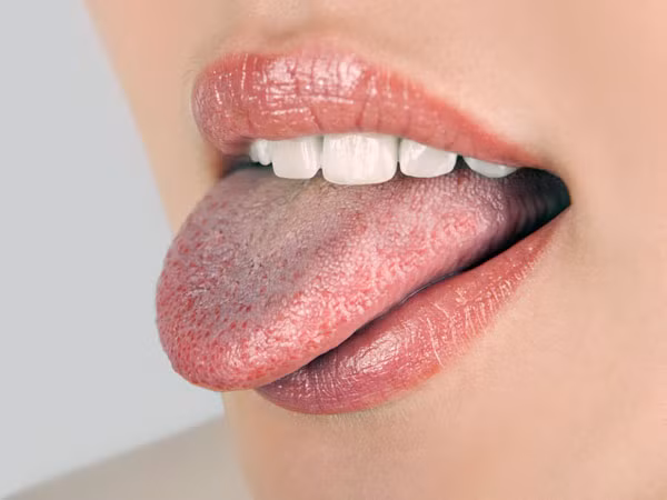 Có nhiều mảng trắng trên lưỡi. Những mảng trắng trên lưỡi (còn gọi là bạch sản) gây ra bởi sự tăng trưởng quá mức của các tế bào độc hại do hút thuốc lá.