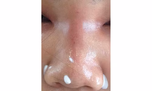 Phần mũi, mặt sưng vù, mưng mủ của chị A. - ẢNH DO BỆNH VIỆN CUNG CẤP Phần mũi, mặt sưng vù, mưng mủ của chị A. - ẢNH DO BỆNH VIỆN CUNG CẤP