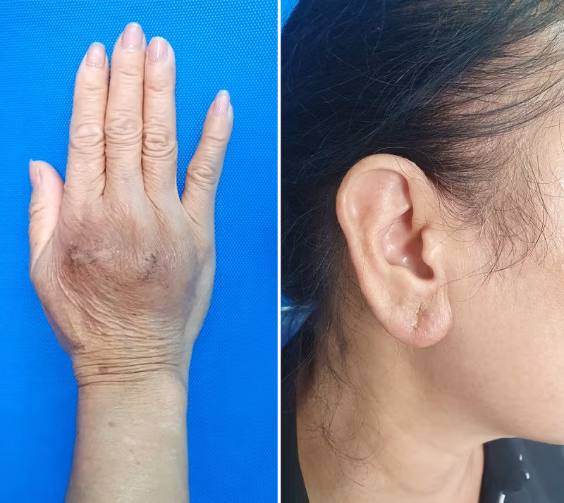 Tiêm filler “chui” gây loạt biến chứng đáng sợ - Hình 2 Tiem filler “chui” gay loat bien chung dang so-Hinh-2