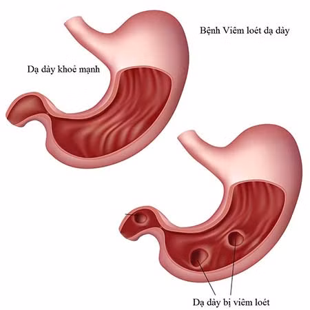 Có bệnh viêm đường ruột. Những người mắc bệnh viêm đường ruột thường có nguy cơ cao bị sỏi hơn những người khác, đặc biệt là bệnh viêm loét đại tràng. Do những bệnh này làm tăng nguy cơ mất nước và kéo theo hóa chất gây sỏi thận ở nước tiểu.