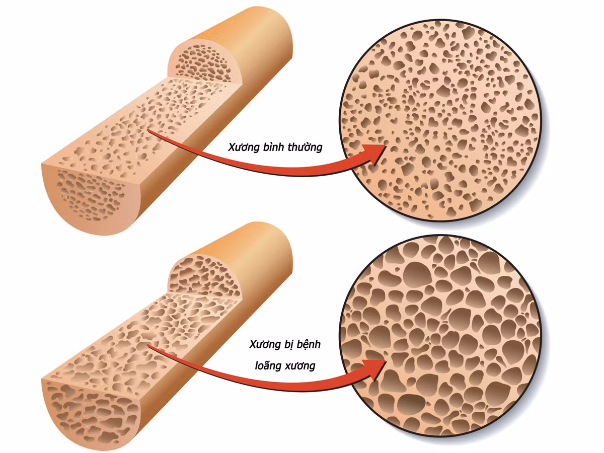 Hơn nữa, các đĩa đệm cột sống nằm giữa các đốt xương sống giống như các miếng cao su. Những cái đĩa này co lại một cách tự nhiên và thay đổi hình dạng khi chúng ta già đi - chủ yếu do mô và nước bị mất.