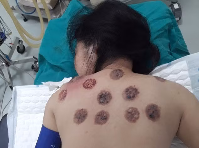 Kinh hoàng lưng nhiễm trùng, chảy máu lẫn mủ vì đi giác hơi Kinh hoang lung nhiem trung, chay mau lan mu vi di giac hoi