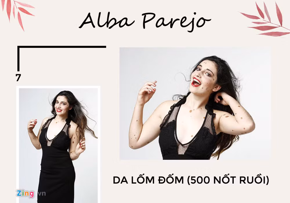 Alba Parejo mắc bệnh Melanocytic Nevus bẩm sinh nên sở hữu làn da lốm đốm bớt và nốt ruồi. Từ cô gái từng tủi thân vì bị ví như quái vật, Alba của ngày hôm nay đã trưởng thành hơn, tự tin xuất hiện trên các bảng tin, quảng cáo và mặt báo.