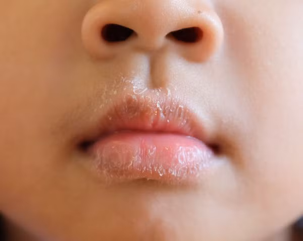  Khô miệng và sâu răng. Khi thở bằng miệng, luồng không khí sẽ làm khô môi và khoang miệng, trong đó bao gồm cả nướu. Điều này làm thay đổi môi trường vi khuẩn sống trong miệng, gây các vấn đề về nướu, sâu răng.