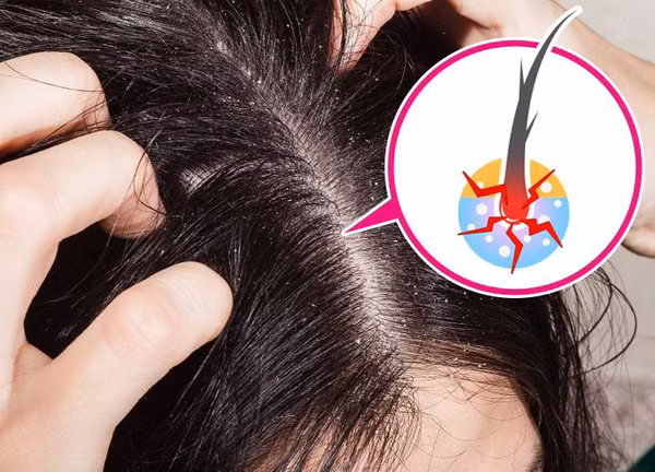 Gãi đầu quá mạnh. Gãi mạnh làm lớp biểu bì bị hỏng, nang tóc ảnh hưởng. Lời khuyên cho bạn là nên massage nhẹ nhàng trong quá trình gội. Thực hiện chế độ ăn lành mạnh, tăng cường bổ sung protein, vitamin A, D và E cũng có tác dụng cải thiện tình trạng.