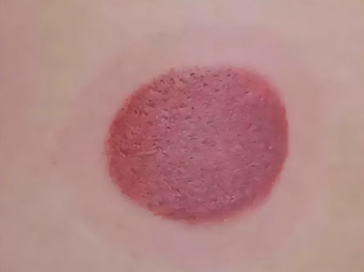 Giác hơi giúp thải độc tố? Sự thật kinh ngạc - Hình 2 Giac hoi giup thai doc to? Su that kinh ngac-Hinh-2