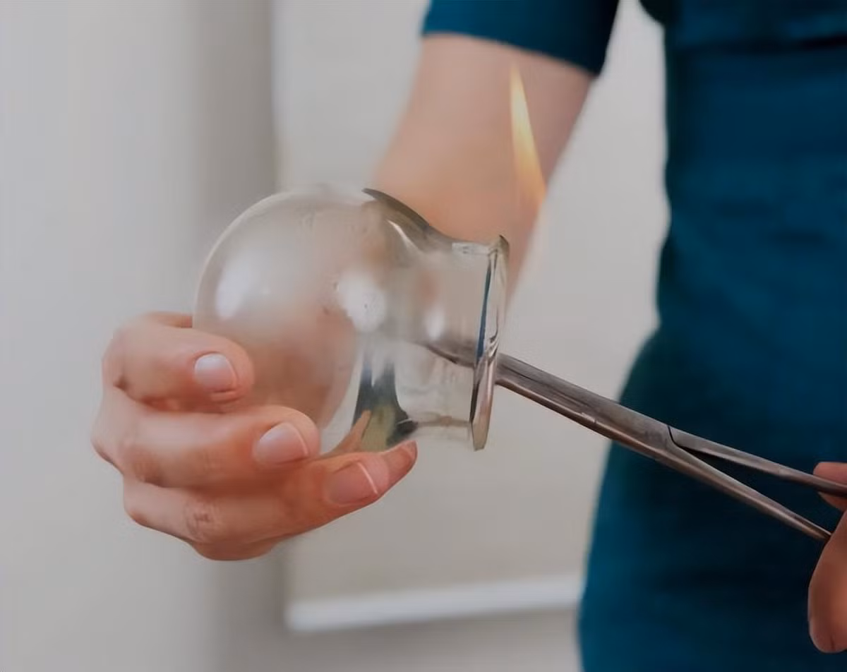 Giác hơi giúp thải độc tố? Sự thật kinh ngạc Giac hoi giup thai doc to? Su that kinh ngac