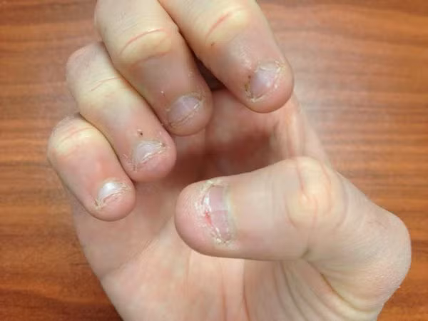 Trong nước bọt có các thành phần hóa học giúp phân hủy chất béo và thực phẩm, vì vậy nước bọt có thể làm xuất hiện mụn ở đầu ngón tay bạn thường xuyên cắn. (Nguồn Twimg)