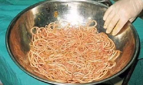 Giun chui len lo mui qua ong thong da day