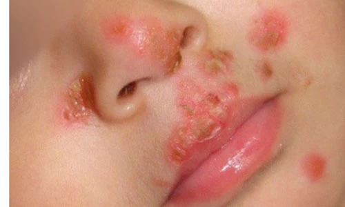 Top bệnh nguy hiểm lây rất dễ khi mẹ hôn môi con