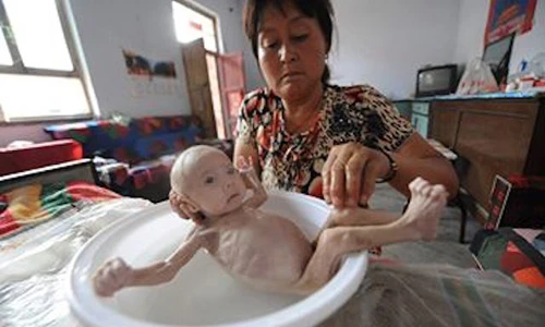 Thảm cảnh em bé da bọc xương, bụng căng đầy chất thải